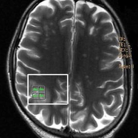 Mri Of Brain T2 Weighted Showing Multiple Hyperintense Lesions In