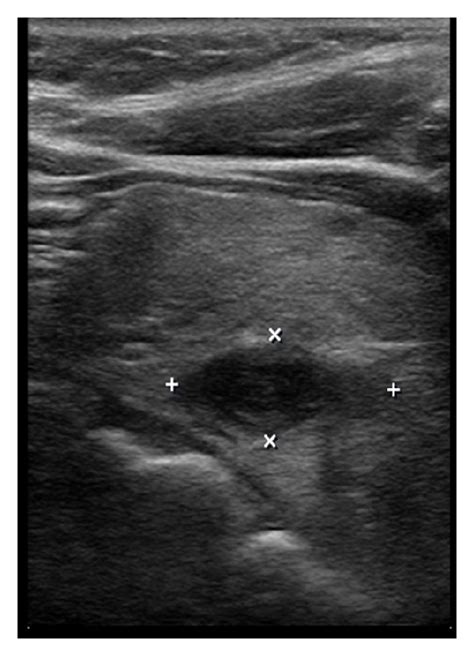 Normal Parathyroid Ultrasound