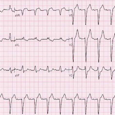Ecg Showing Complete Lbbb With Prolonged Pr Interval Download