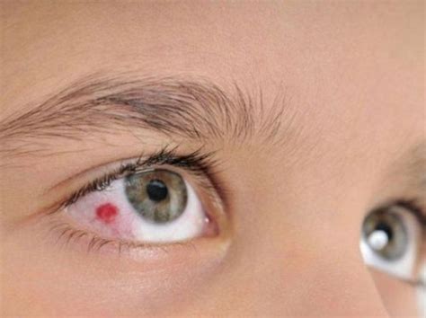 Blood In The Eye What To Do Causes And Remedies From Doctor