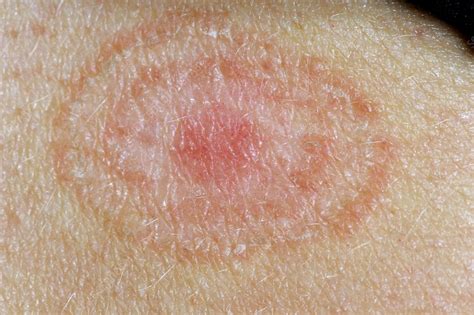 Ringworm Tinea Fungal Skin Infection Stock Image C0117541 Science Photo Library