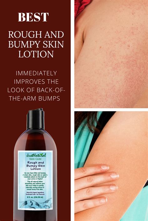 Rough Bumpy Skin Lotion You Can Finally Treat Those Annoying Back Of