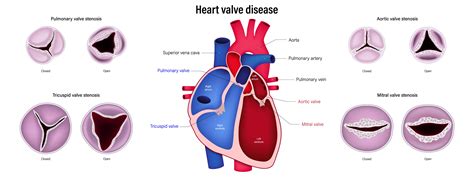 Heart Valve Replacement Understanding Heart Valve Diseases And Treatment Options Meril
