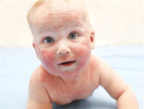 Little Baby With Dermatitis On Face Bioptimizers