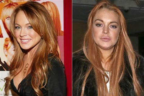 Lindsay Lohans Plastic Surgery Before And After Botoxtips Hair