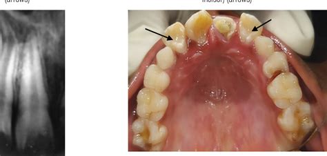 Figure From Occurrence Of Dens In Dente In Permanent Maxillary