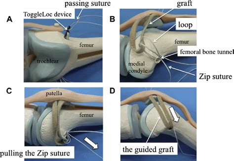 Guidance Of Tendon Graft First The Patellar Side Of The Tendon Graft