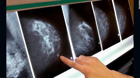 New Breast Cancer Screening Guidelines Cnn