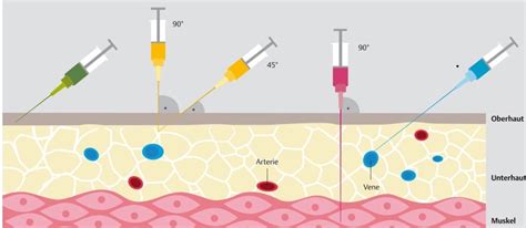 Injektion Und Infusionen Diagram Quizlet