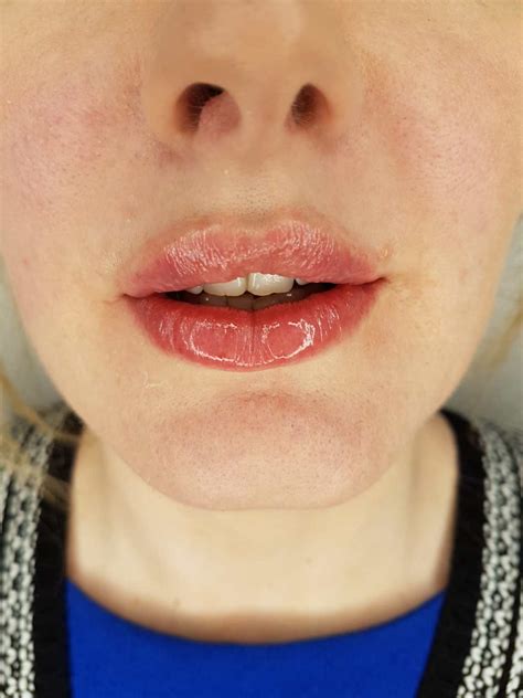 Lip Fillers Everything You Need To Know The Dental House