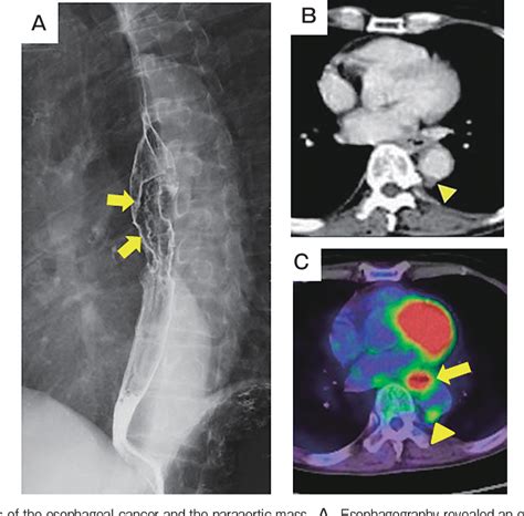 Figure 1 From Esophageal Cancer Initially Thought To Be Accompanied By