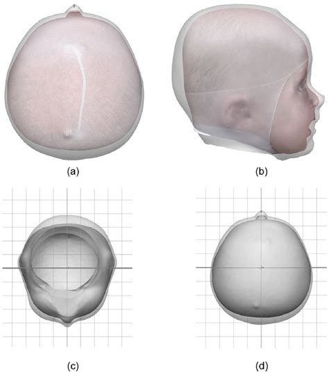 Helmet Treatment Of Infants With Deformational Brachycephaly Kevin M