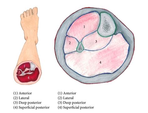 Compartment Syndrome Concise Medical Knowledge