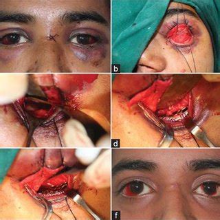 (PDF) Residual diplopia in treated orbital bone fractures