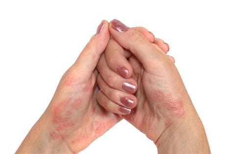 Herbal Remedies For Psoriasis And Eczema Soho Acupuncture Center