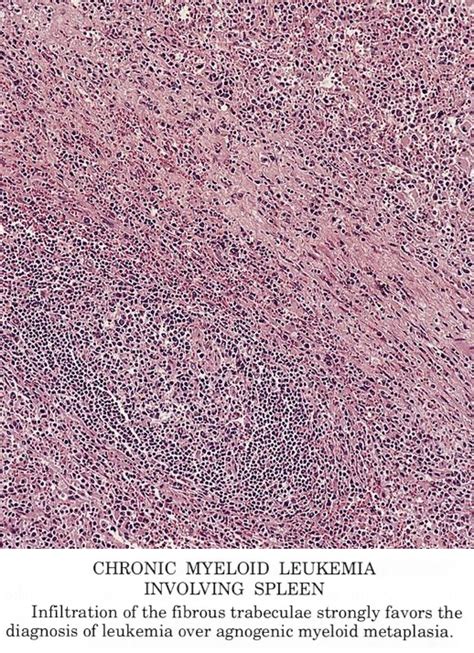 Pathology Outlines Chronic Myelogenous Leukemia