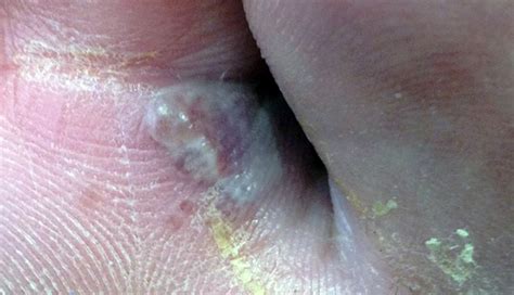 Derm Dx Itchy Blister Between The Toes Clinical Advisor