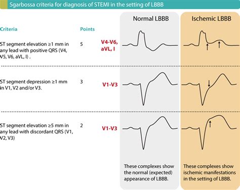 St Segment Elevation Myocardial Infarction
