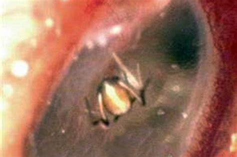 Spider Found Weaving Web In Womans Ear After She Heard Scratching
