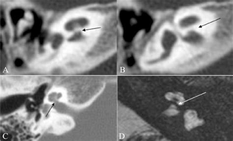 A D Isolated Cochlea Axial Hrct Images A B Show A Thick Bony Bar
