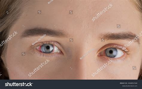 Young Woman Burst Blood Vessel Eye Stock Photo 2068852568 Shutterstock