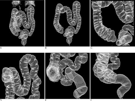 Figure 1 From Is A Double Contrast Barium Enema Necessary In Patients