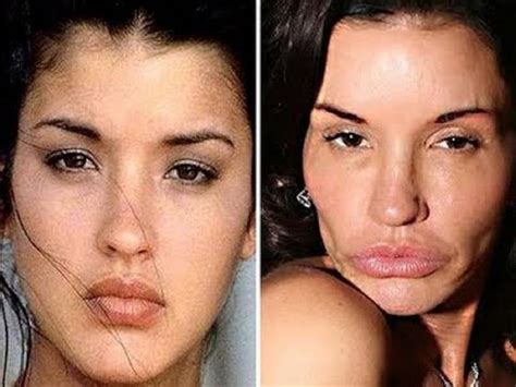 15 Celebrities Whose Plastic Surgeries Went Wrong Pics