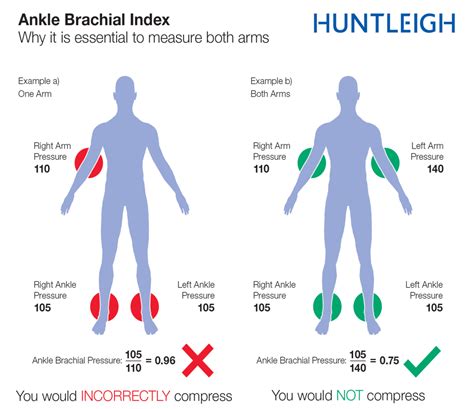 How To Calculate Ankle Brachial Pressure Index The Test Is Performed