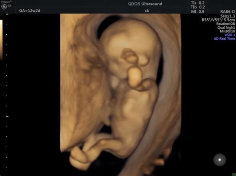 12 Week Scan Perth Pregnancy Ultrasound At 12 Weeks Qdos Perth