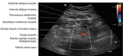 Lumbar Paravertebral Sonography And Considerations For Ultrasound