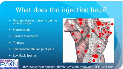What do trigger point injections treat? Overview of Trigger Point Injections Explained by a NJ ...