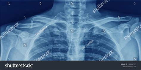 Anteroposterior Radiograph Xray Both Clavicle Collarbone Foto Stock