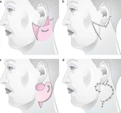 Opposing Transposition Flaps Facial Plastic Surgery