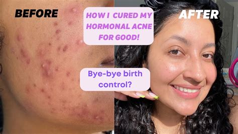 The Journey That Changed My Skin My Acne Story Revealed Youtube
