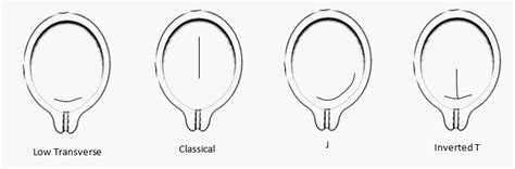 Cesarean Section Epomedicine