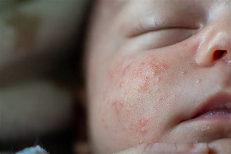 Common Newborn Rashes Pediatrics West