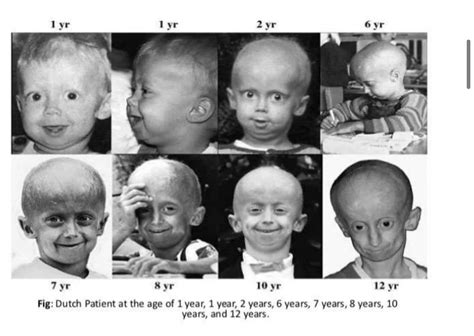 Progeria Life Expectancy