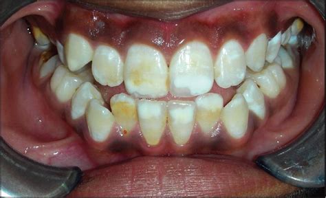 Dentistry And Medicine Molar Incisor Hypomineralization