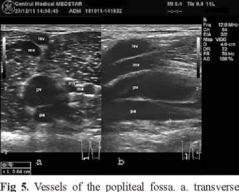 Figure 5 From Ultrasound Examination Of The Femoral And Popliteal