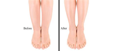 Cankles Definition Exercise Surgery Learn From Doctor