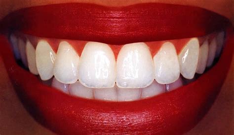 Tea and coffee stains on your teeth occur over time. How to Get Rid of Yellow Stains on Teeth Naturally