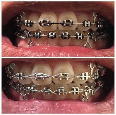 Braces Girlswithbraces Metalbraces Loops Teeth Braces Metal Braces Braces Rubber Bands