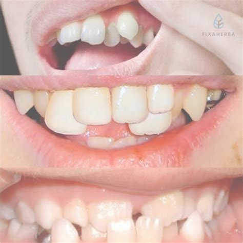 Susunan Gigi Tidak Rapi Pilih 8 Perawatan Gigi Ini