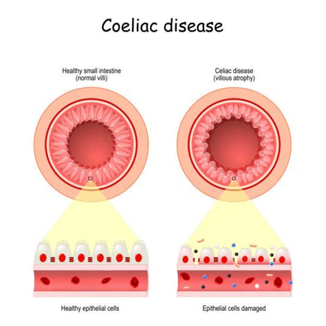 Celiac Disease Illustrations Royalty Free Vector Graphics And Clip Art