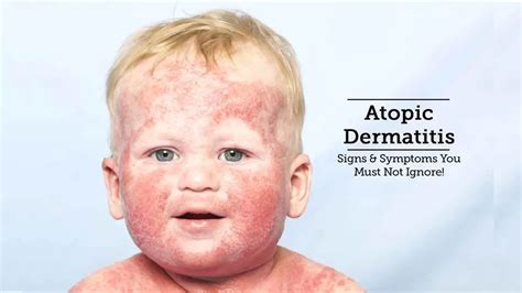 Atopic Dermatitis In Children Causes And Treatment