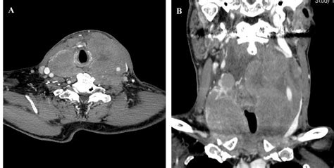Primary Thyroid Lymphoma As A Manifestation Of Rapidly Growing Thyroid