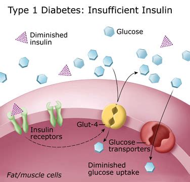 Biochemistry Class notes: TYPE 1 DIABETES MELLITUS AND ITS AETIOLOGY