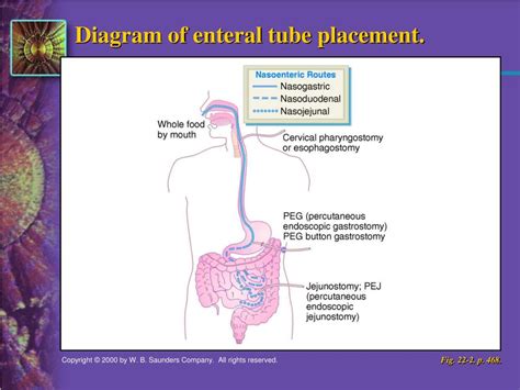 Ppt Nursing Considerations For Enteral Tubes Powerpoi