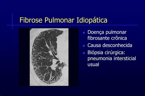 Ppt Fibrose Pulmonar Idiop Tica E Hipertens O Pulmonar Ii Curso Nacional De Circula O