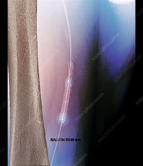 Leg Artery Angioplasty Angiogram Stock Image C0489313 Science
